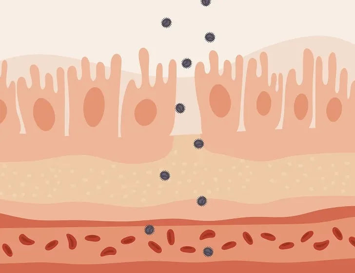 Ilustración de la pared del intestino debilitada