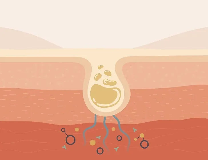 Ilustración del poro produciendo sebo